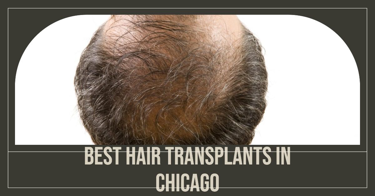 Best Hair Transplants In Chicago